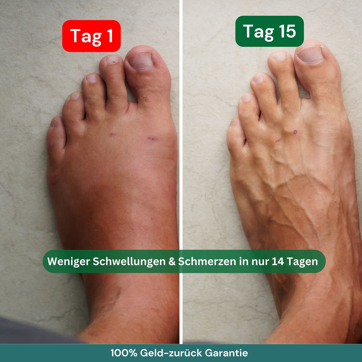 popyy® Kompressionsstrümpfe für geschwollene, schwere Beine